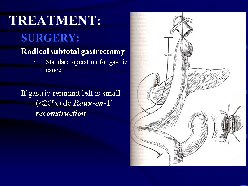 TREATMENT: SURGERY: Radical subtotal gastrectomy Standard operation for gastric cancer  If gastric remnant